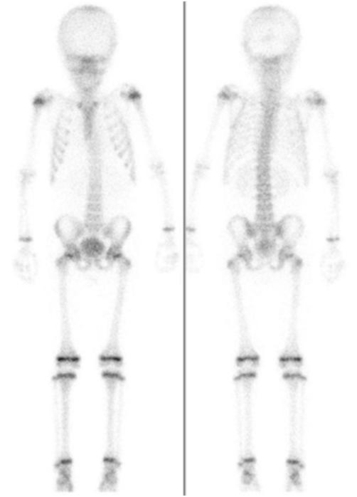 Knochenszintigrafie eines siebenjährigen Kindes